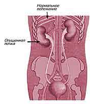 Нефроптоз.Лечение нефроптоза.Лечение почек